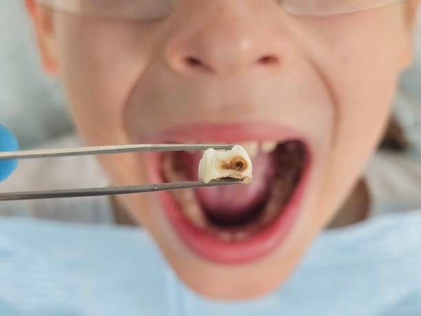 Best Urgent Dental Care for Toothache in Princeton, MO